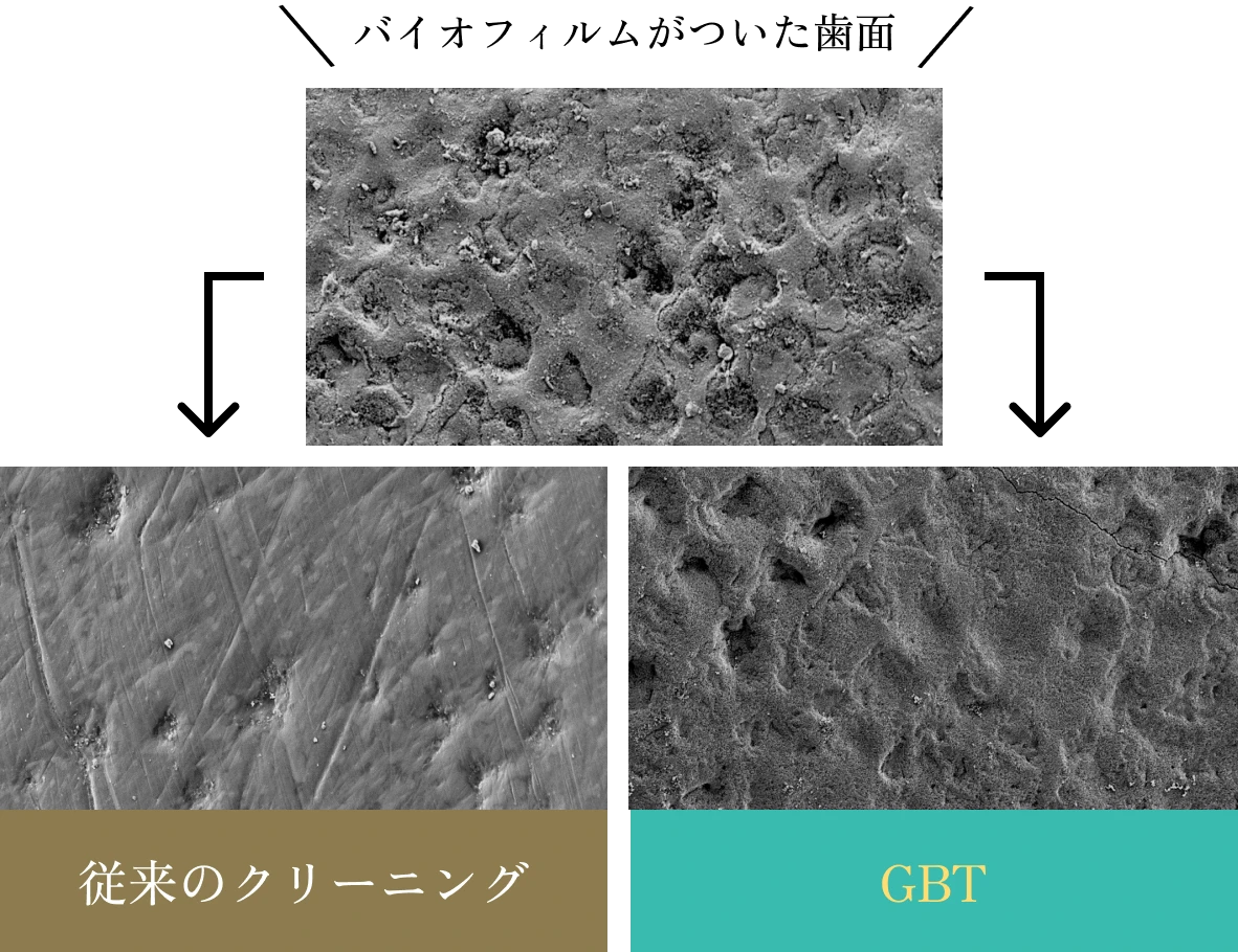 歯や歯茎を傷つけないお口にやさしいクリーニング