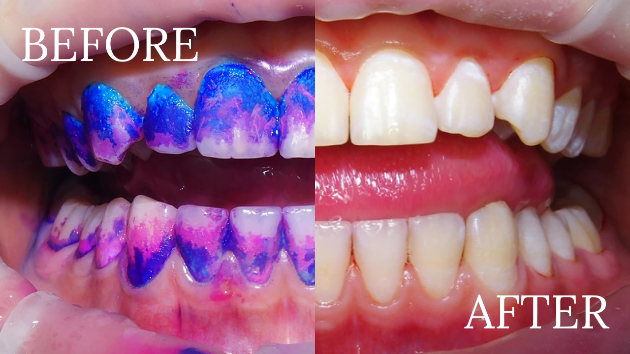 バイオフィルム可視化により的確な処置が可能に