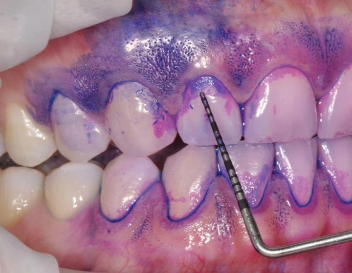 バイオフィルムの染出し