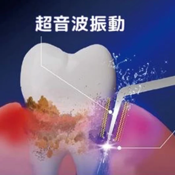 歯茎の切開を回避