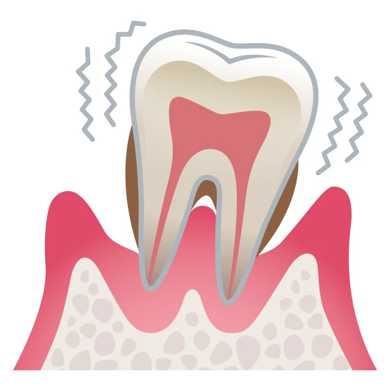 歯のぐらつきの安定化