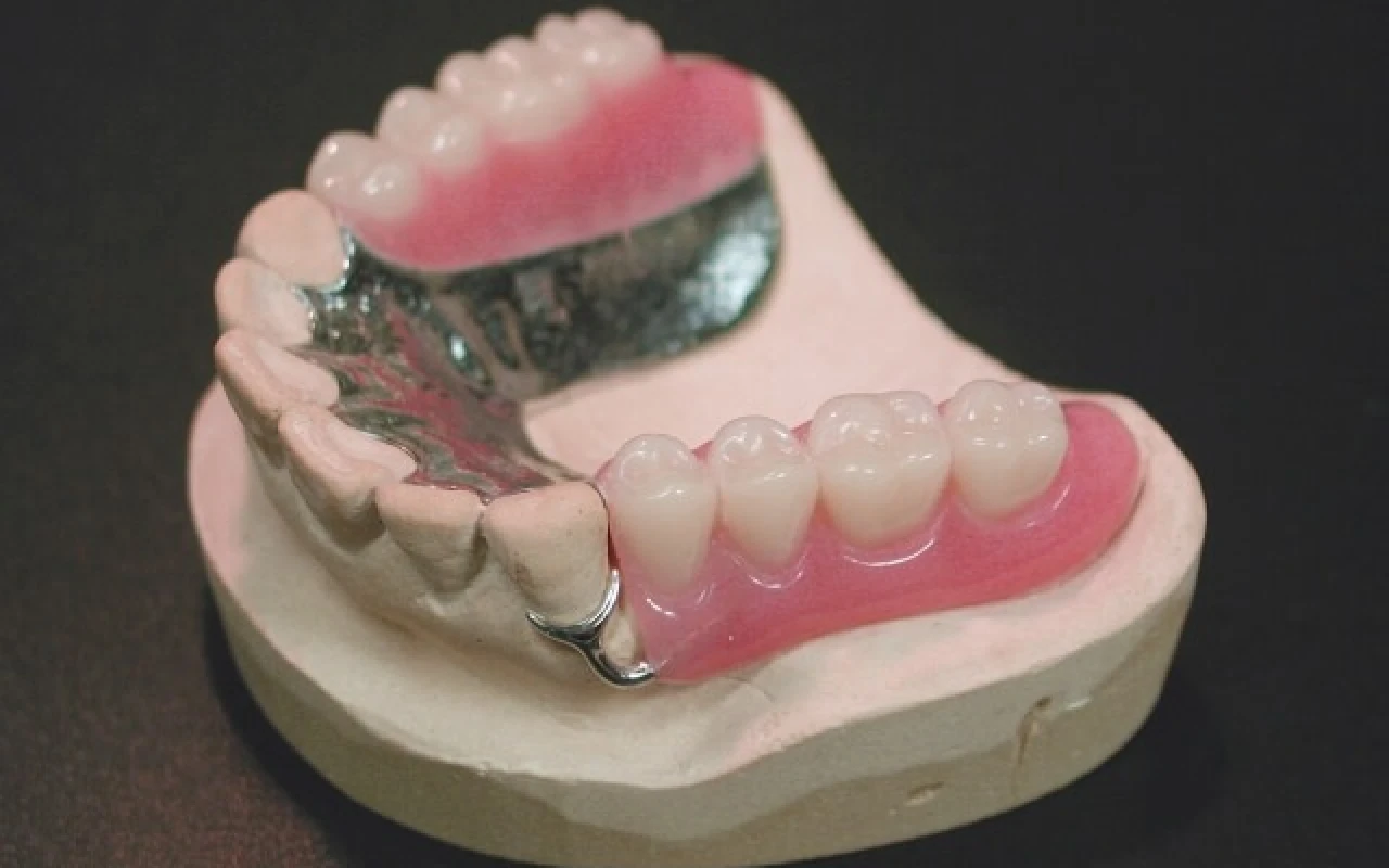 メタルプレート（金属床）デンチャー